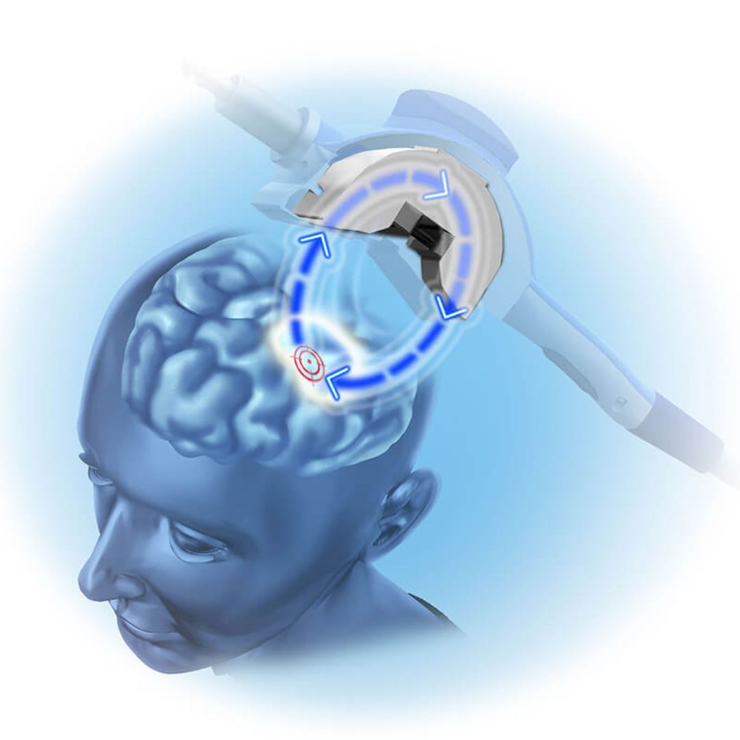 TMS vs. Electroconvulsive Therapy (ECT) Understanding the Differences